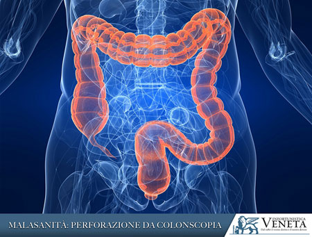 Risarcimento danni per perforazione da colonscopia